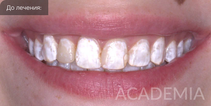 Лечение тяжелой степени флюороза в нашей клинике ACADEMIA