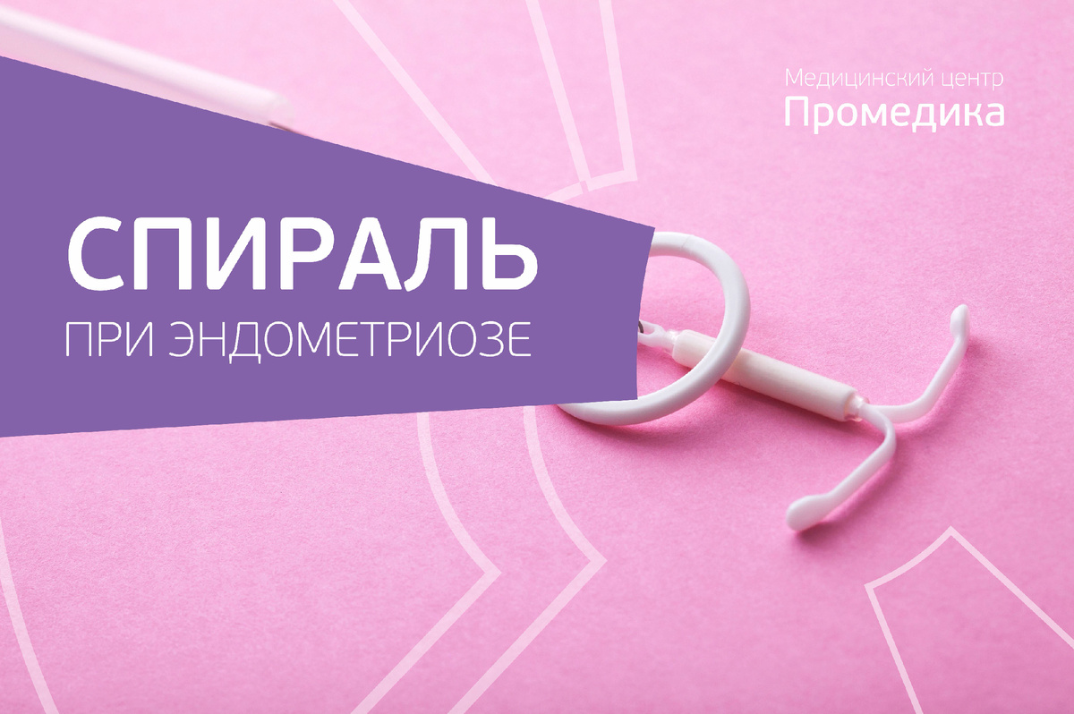 Спираль (ВМС) при эндометриозе. Жизнь без боли и ограничений