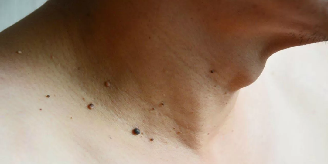 Что это на коже - акрохордон или папиллома? В чем различия и что делать