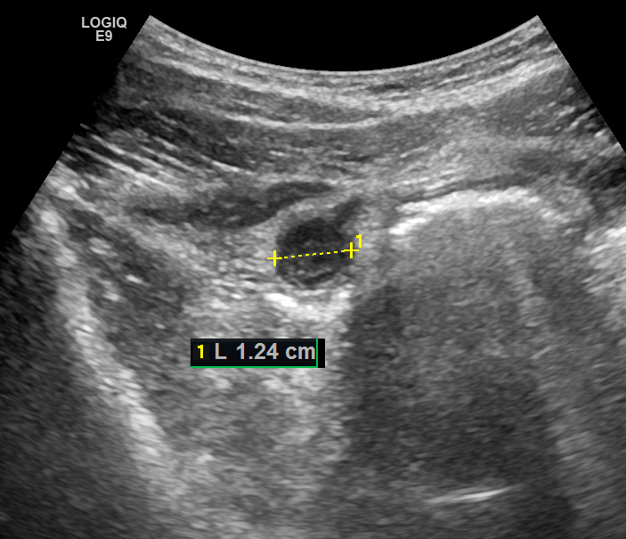 Рис. 01. Поперечное изображение аппендикса. Сканирование конвексным датчиком.
