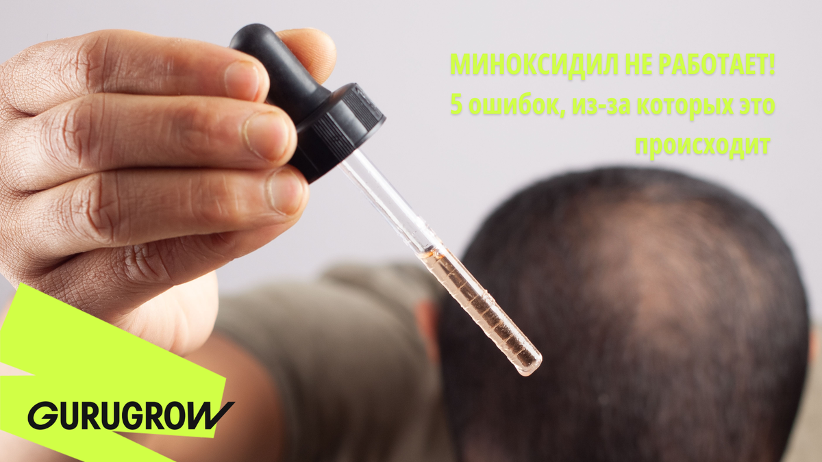 Одно из самый популярных средств – миноксидил. И даже он может не работать.