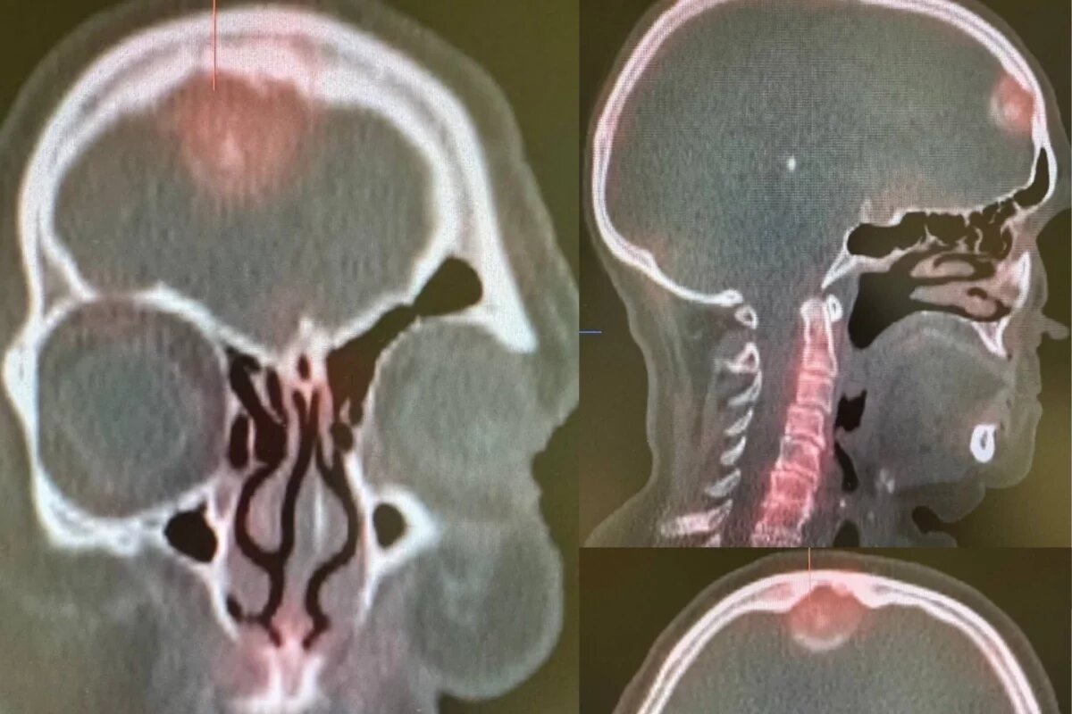    У лечившейся от рака груди псковички обнаружили опухоль мозга