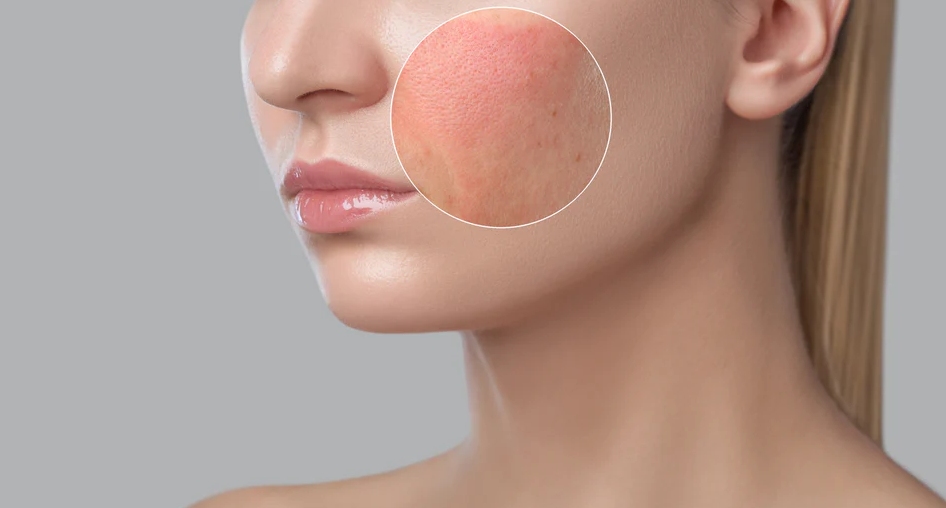 Как восстановить гидролипидный барьер кожи