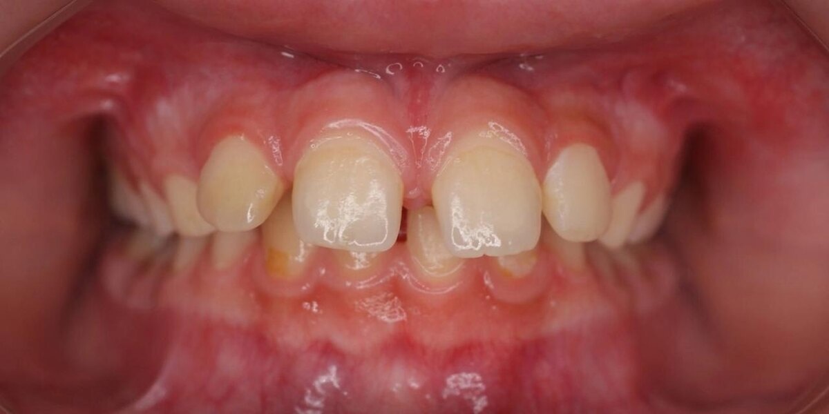 Так выглядит дистальный прикус. 