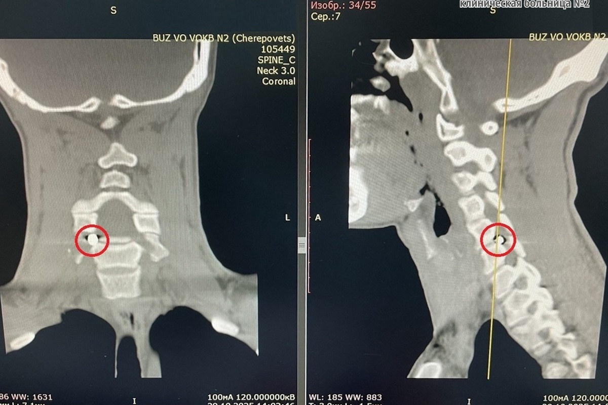    41-летний череповчанин получил минно-взрывное ранение. Во время эвакуации ему оказали медпомощь