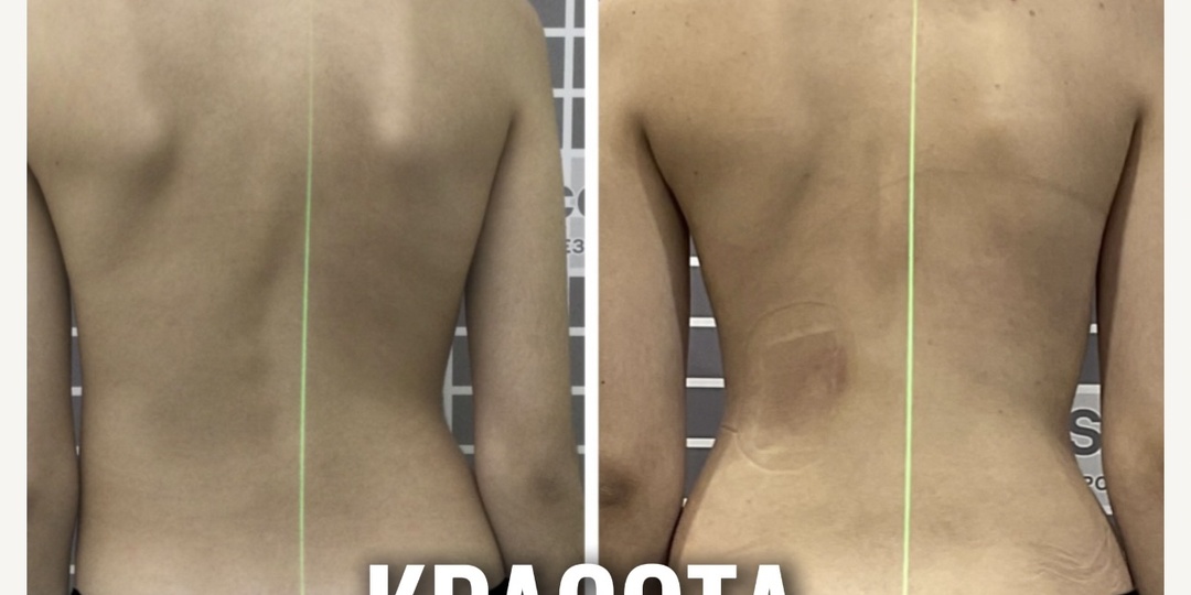 Внешний вид спины при сколиозе сильно изменился!