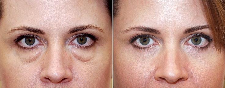 Мешки под глазами: почему они появляются и что с этим можно сделать