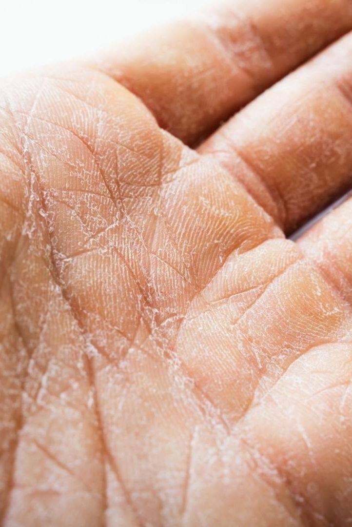 Сухость кожи