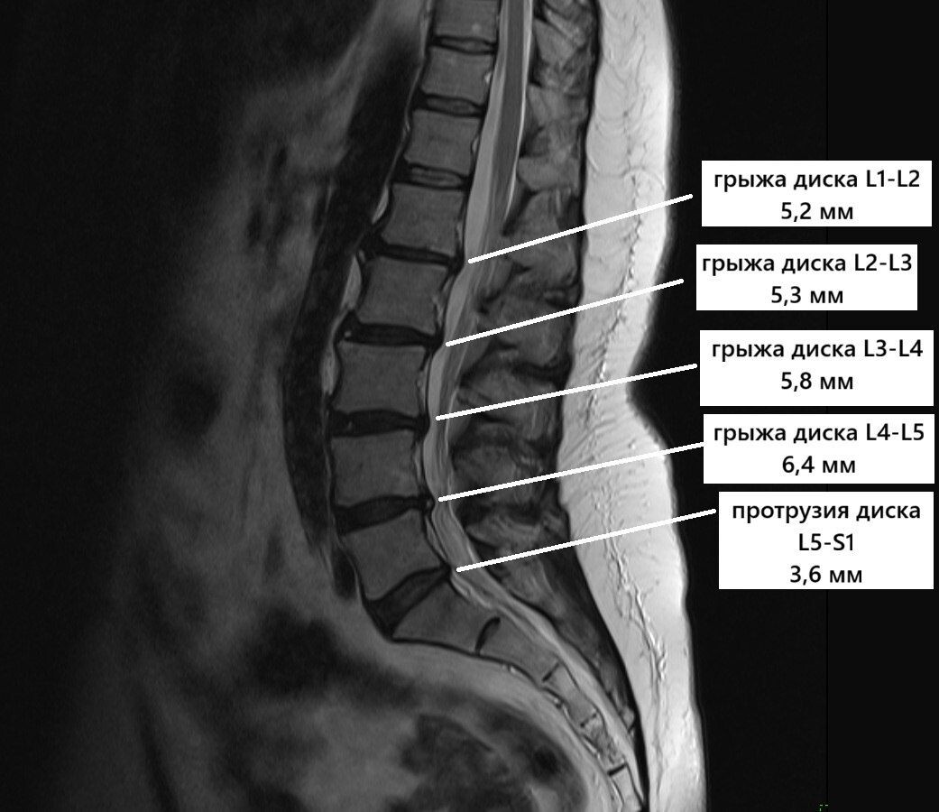 МРТ пациента с множественными крыжами поясничного отдела позвоночника.
