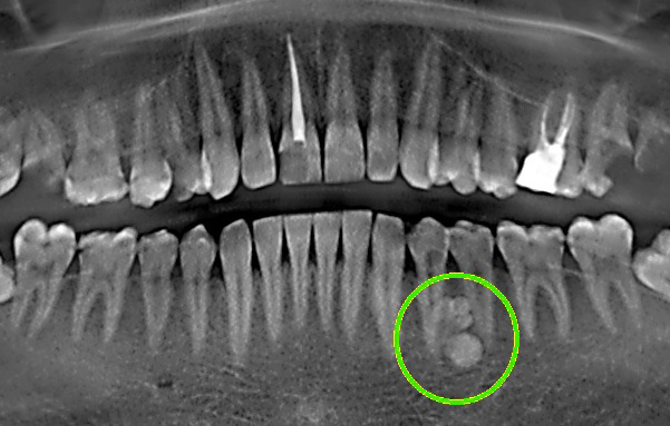 Камни в Челюсти! 😱😱😱😱😱