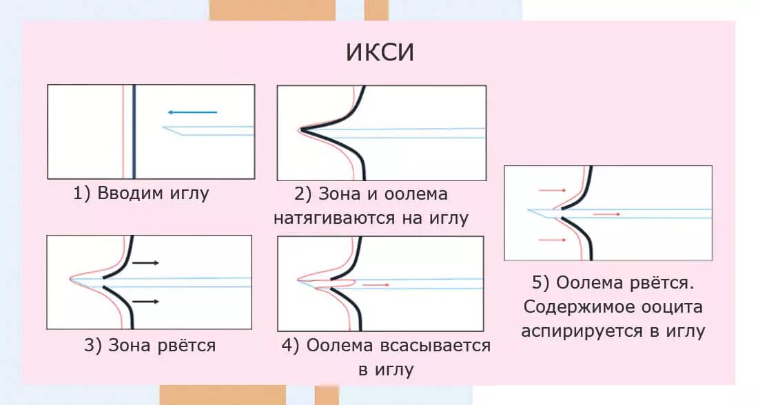 Метод ИКСИ