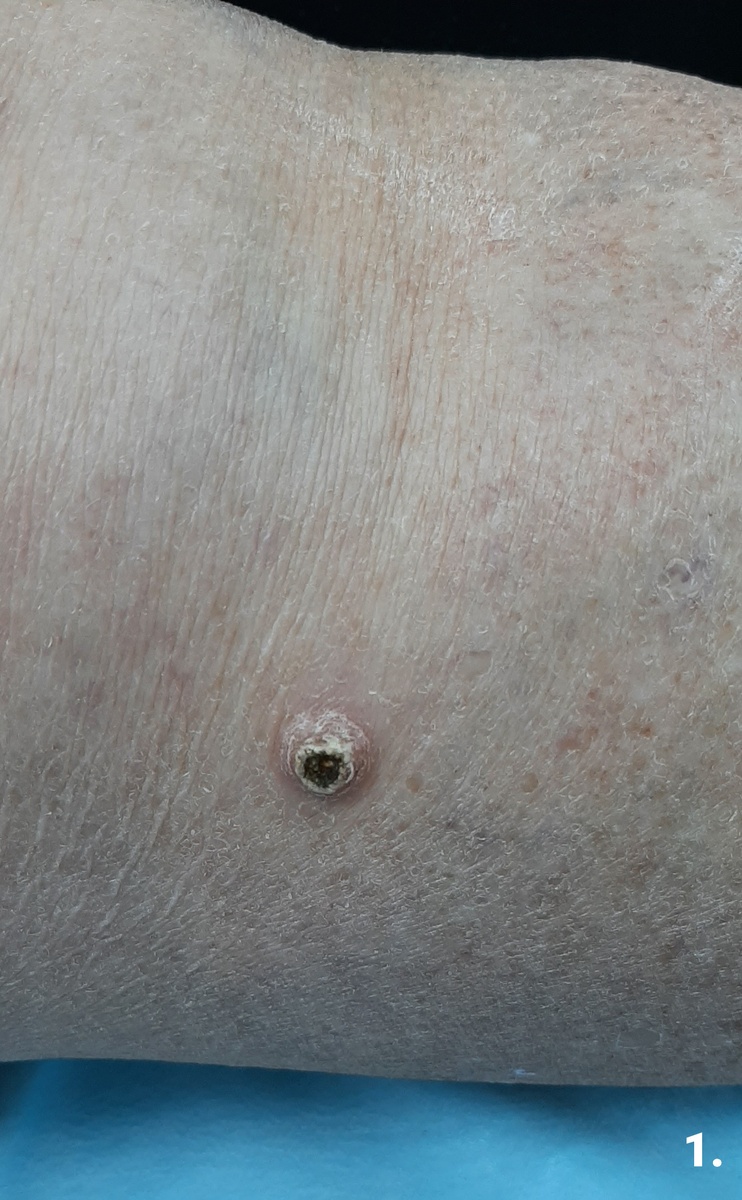 Новообразование кожи голени перед операцией. Фото сделано с небольшим увеличением. Видна сухая корка на вершине опухоли.