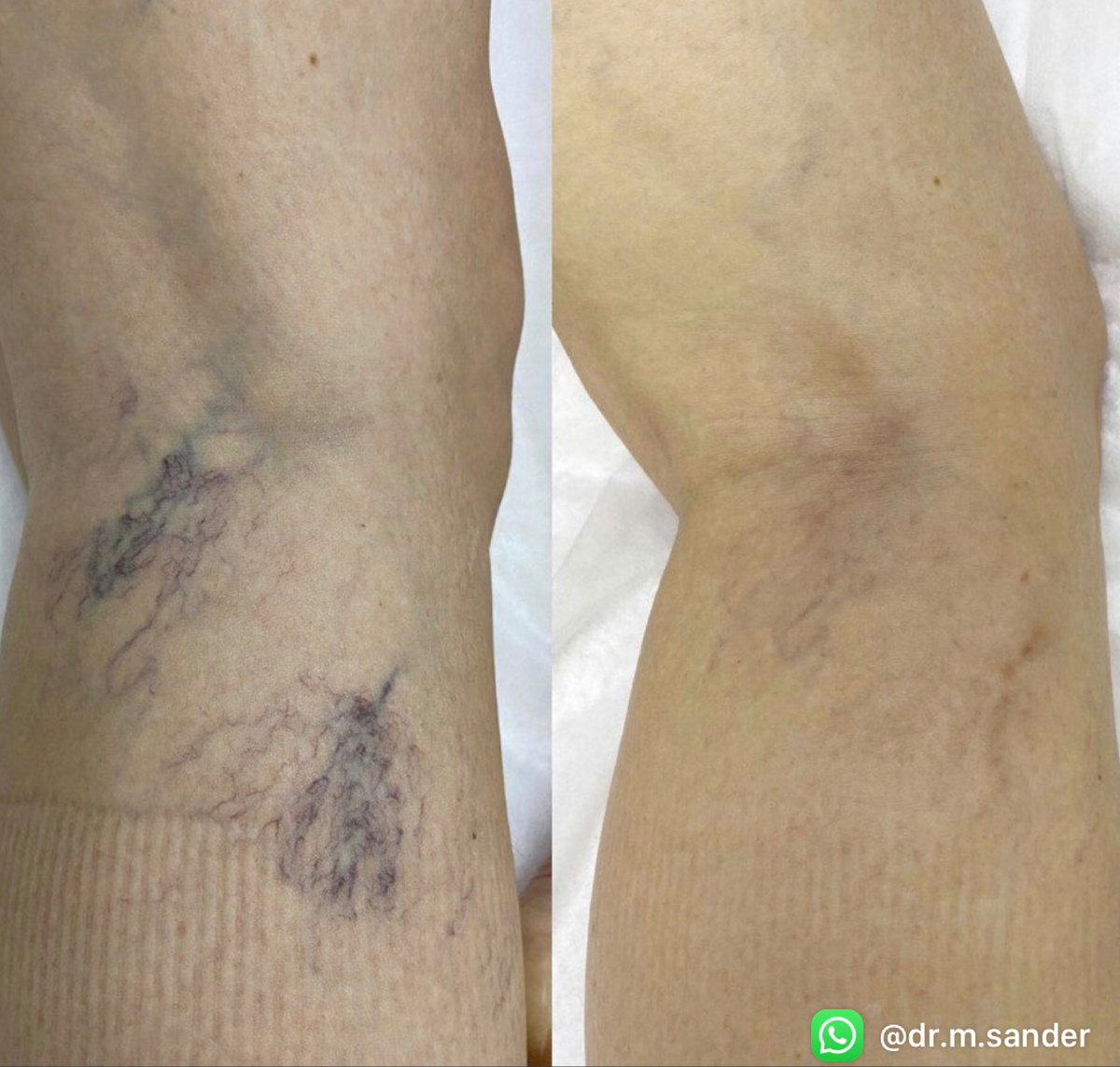 До/после склеротерапии