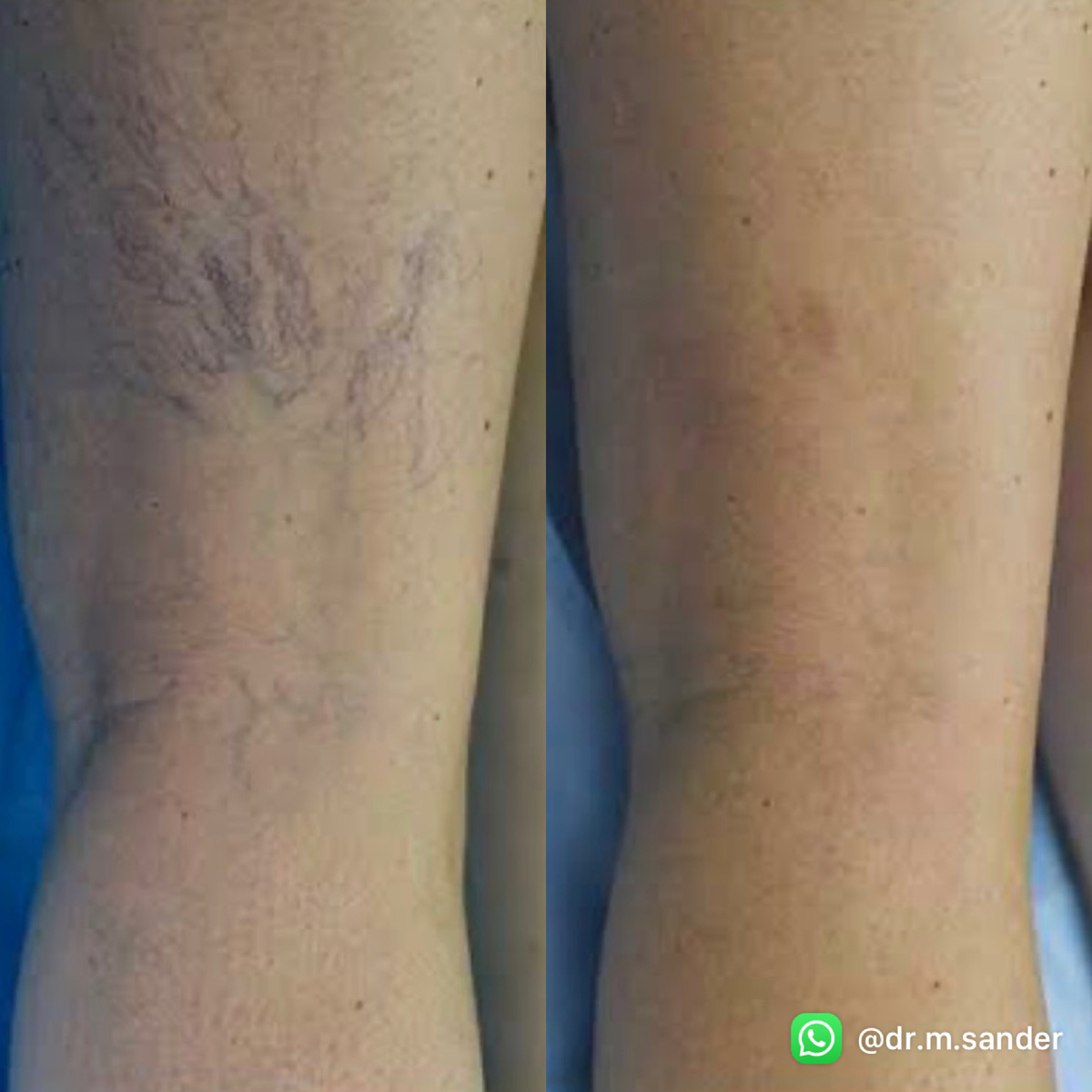 До/после склеротерапии
