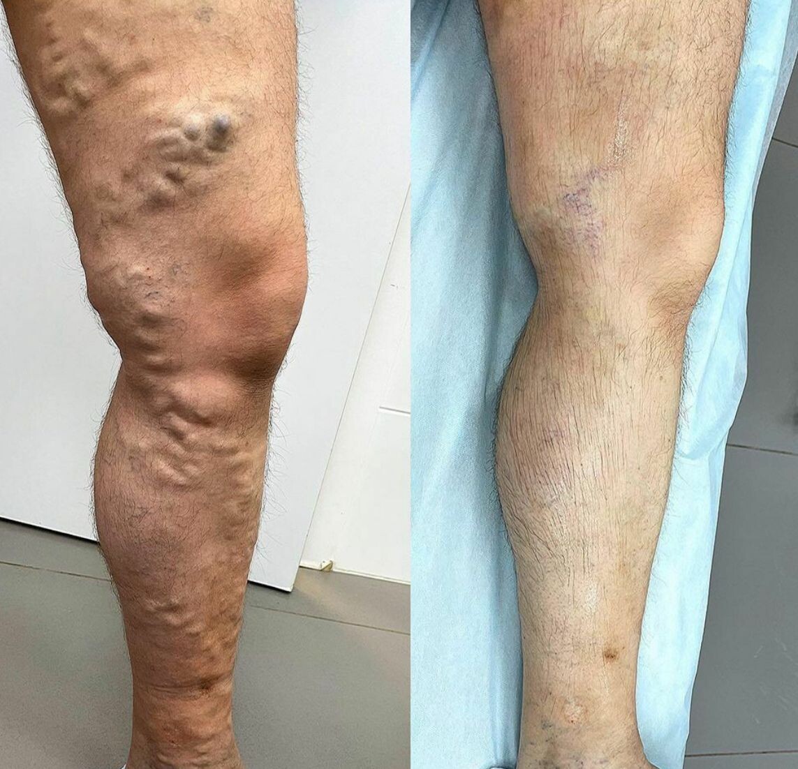 До/после лечения (ЭВЛК)