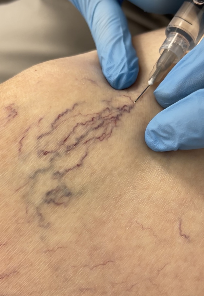 Склеротерапия 