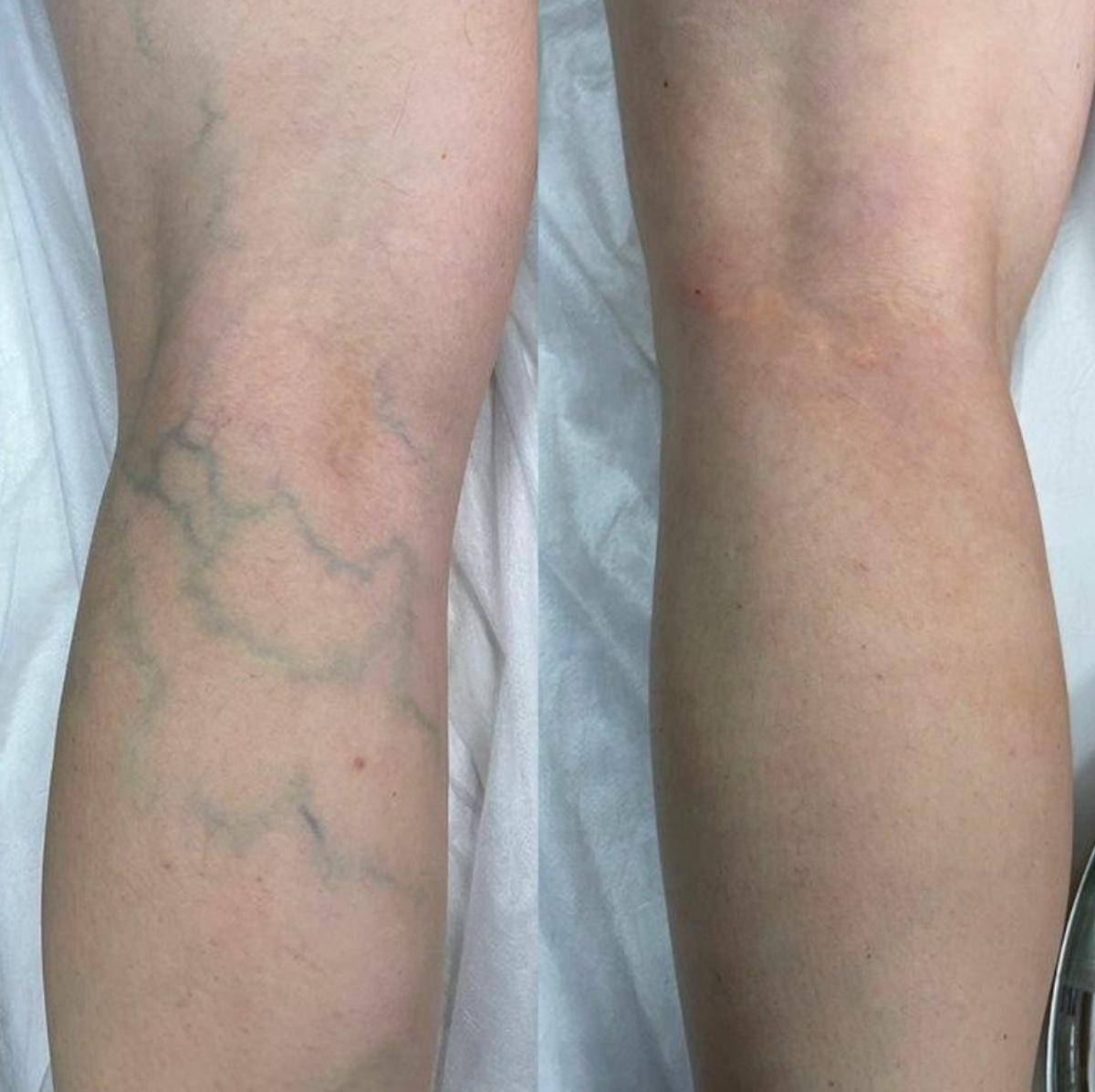 До/после процедуры Склеротерапия 