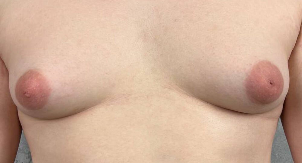 3 недели после лечения гинекомастии