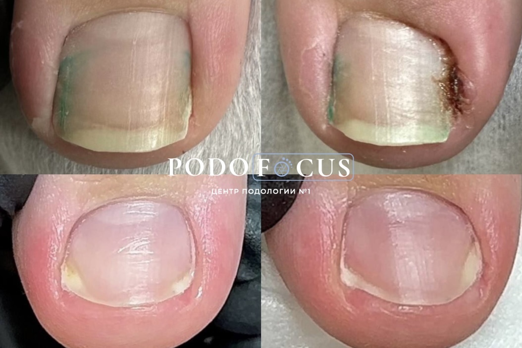 Врастание ногтей из-за не ношения сменной обуви в школе