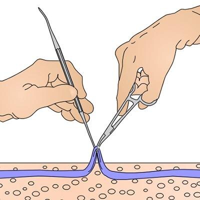 Флебэктомия 