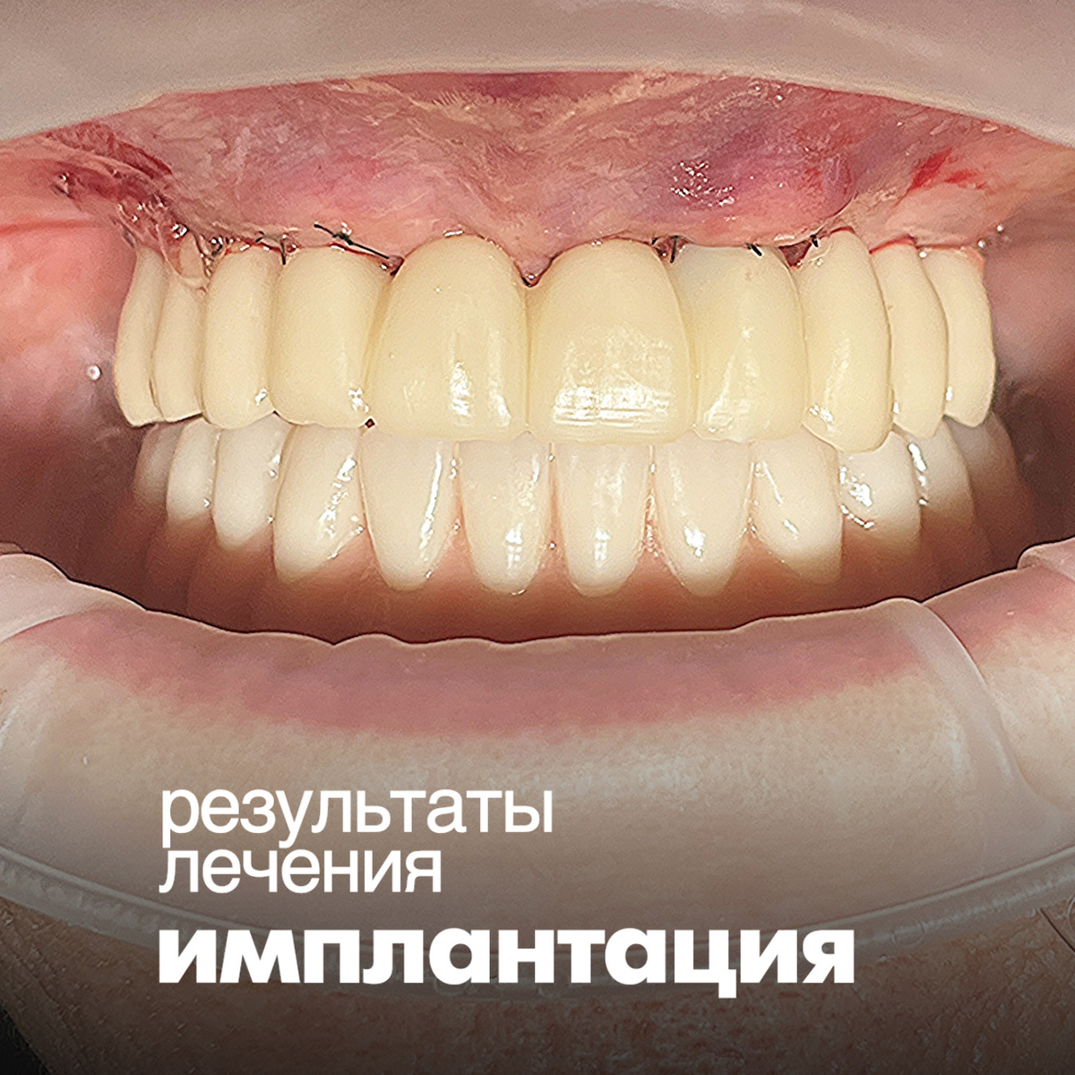 Клинический случай восстановления зубных рядов верхней челюсти «все на 4-х имплантатах NOBEL (Швеция)»