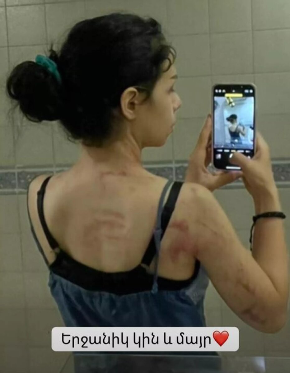 Актриса Мари Петросян опубликовала фотографии насилия © Photo : Social media of Mari Petrosyan