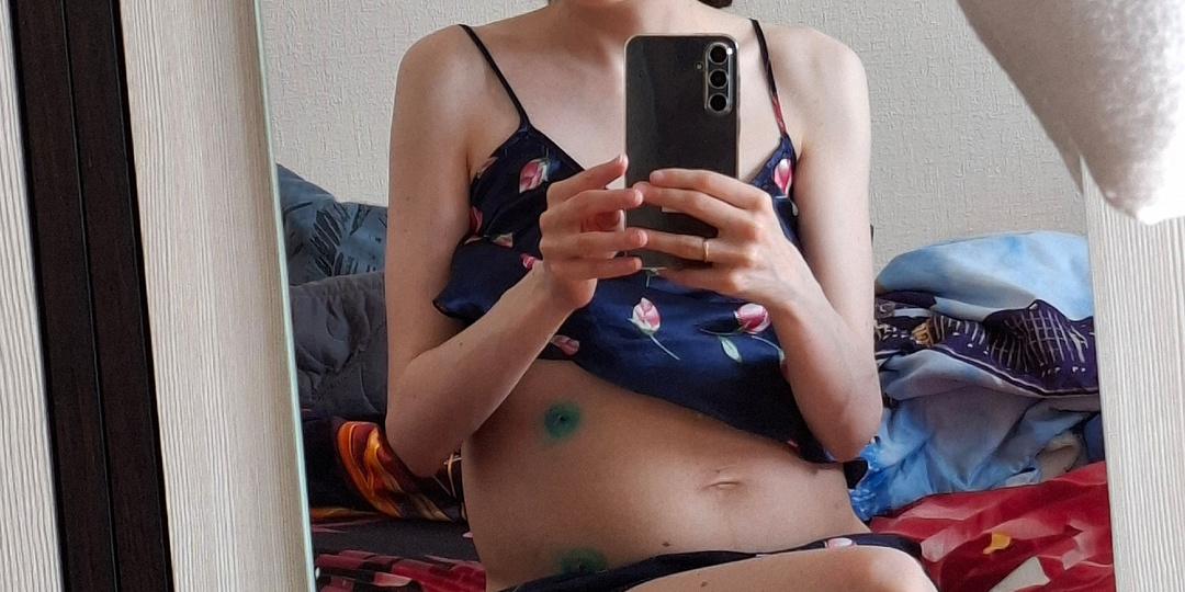 Последствия биопсии и лапароскопии. Пожалела, что дала себя порезать. История болезни ч. 105