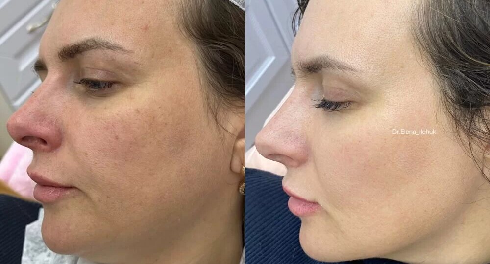 Как избавиться от пигментных пятен