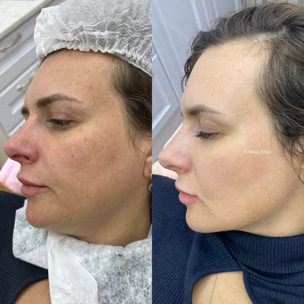 Реальные фото наших клиентов до и после процедуры 