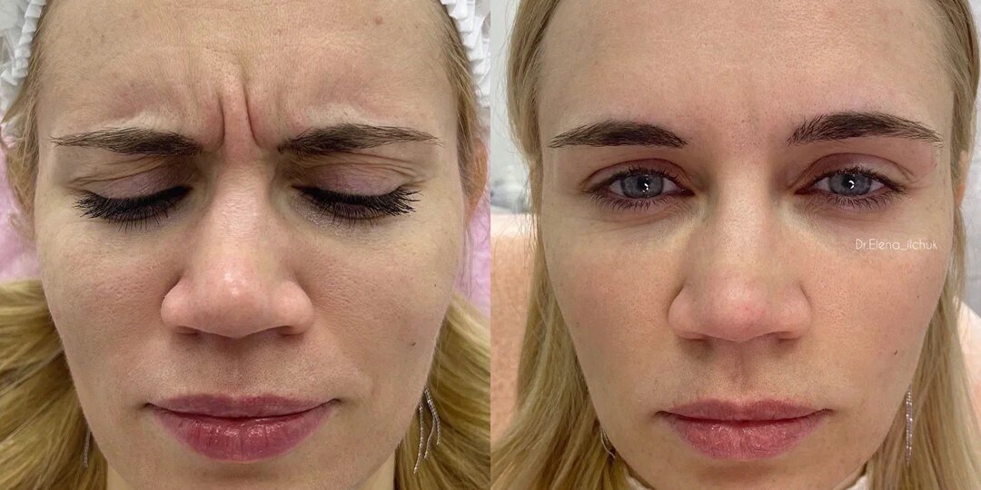 Ботокс для лица - все о процедуре