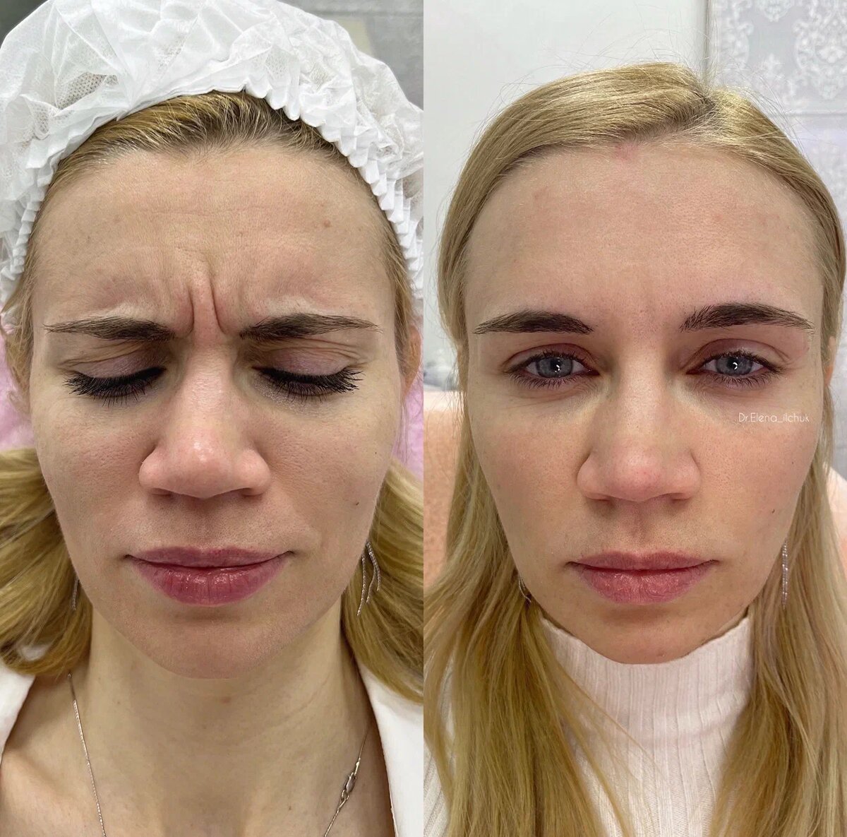 Реальные фото наших клиентов до и после процедуры 