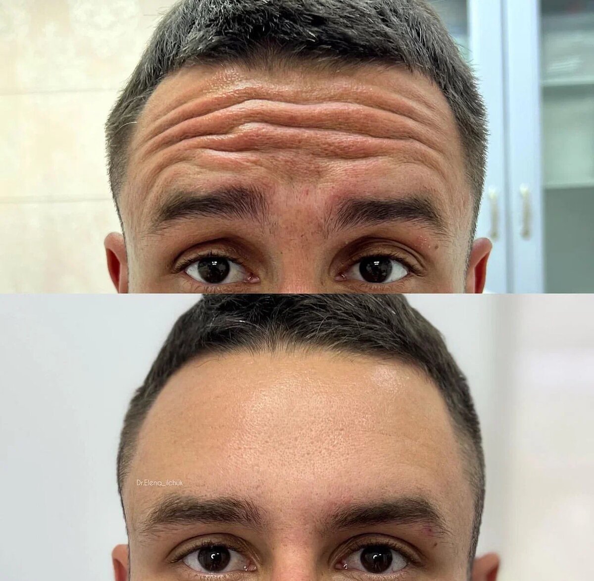 Реальное фото пациента до и после процедуры. Коррекция выполнена в области лба