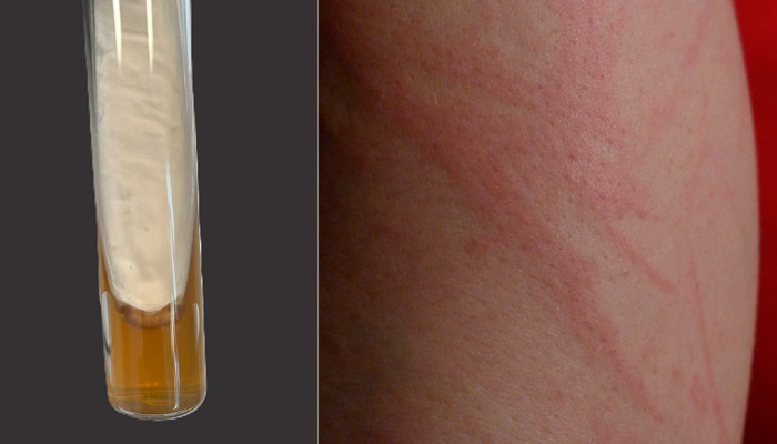 Культура Trichophyton indotineae в пробирке. Использовано изображение из wikimedia.org