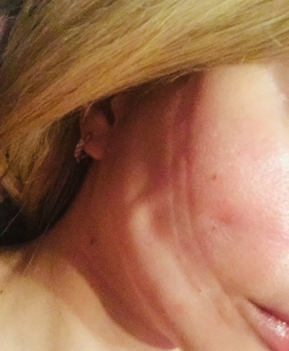 Смотрится страшно, но со временем, буквально в течении месяца, все проходит!