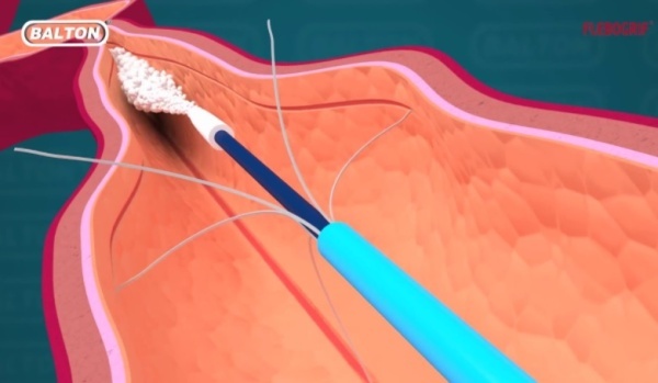 Воздействие Flebogrif (Balton, Польша) на стенку вены
