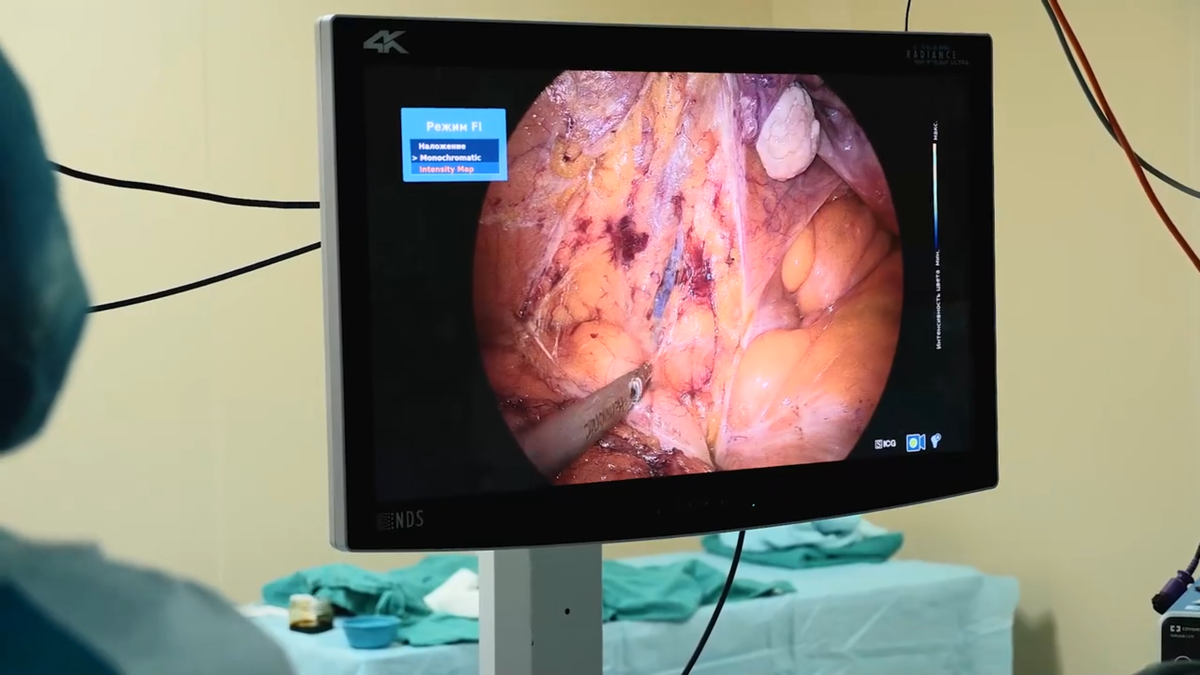 Режим «Intensity Map» в эндовидеосистеме IMAGE1 S RUBINA KARL STORZ позволяет визуально отслеживать степень накопления индоцианина зелёного.