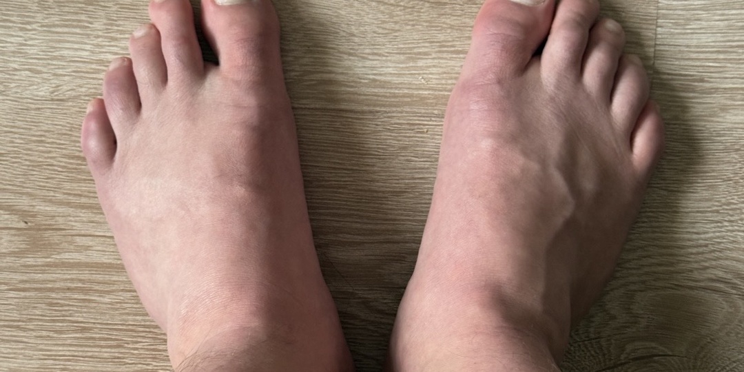 Невролог о главной причине отказа ног при алкоголизме