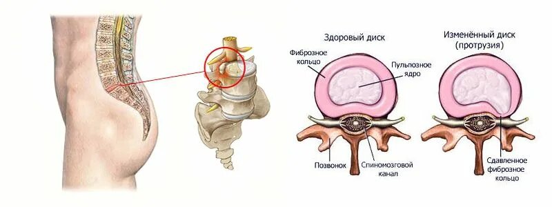 Протрузия и грыжа позвоночника: не приговор, а сигнал — пора прислушаться к своему телу