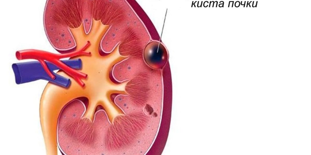 Киста в почке — что это, почему появляется и стоит ли бояться
