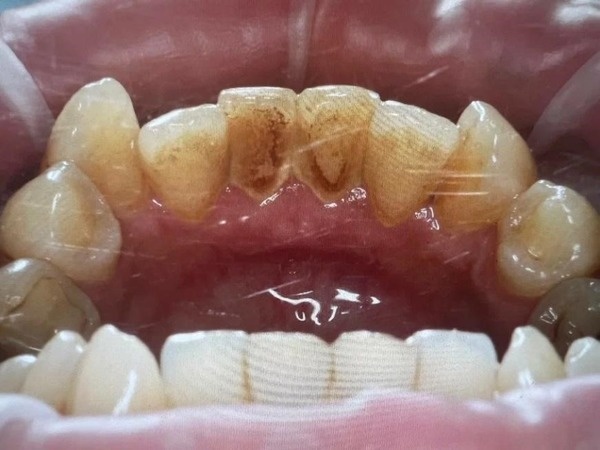 “Никотиновые” зубы: налет и зубной камень на внутренней стороне нижних зубов. При этом внешняя сторона пока что выглядит неплохо.