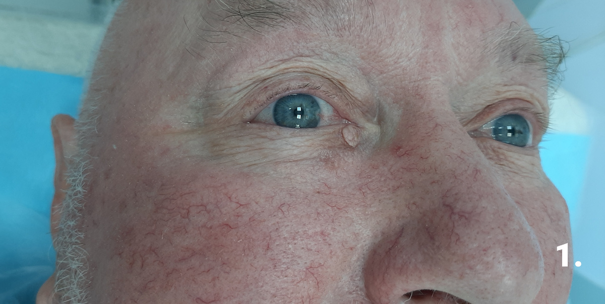 Фото перед операцией. Опухоль кожи века расположена у внутреннего угла глаза.