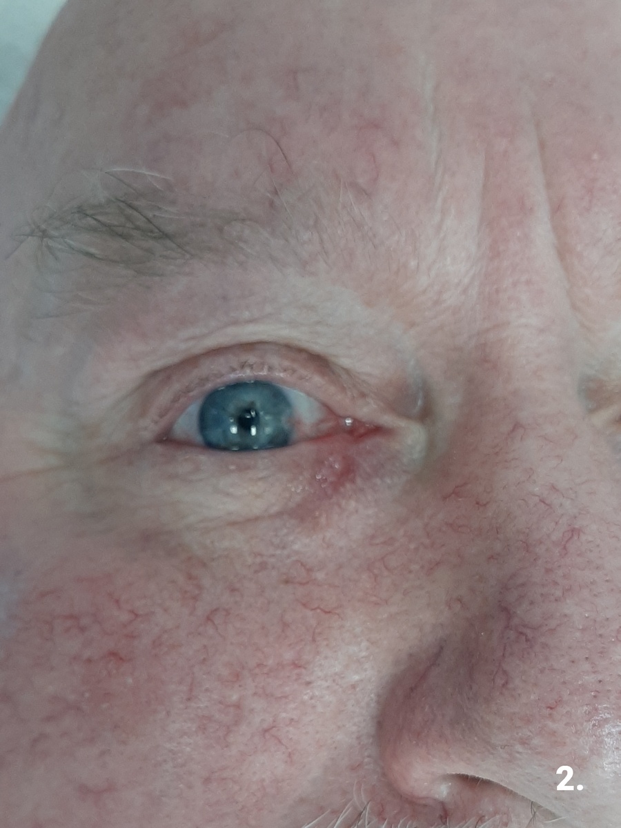 При удалении нити была также удалена корка и на фото видна поверхностная эрозия. Вскоре эрозия сгладится и исчезнет.