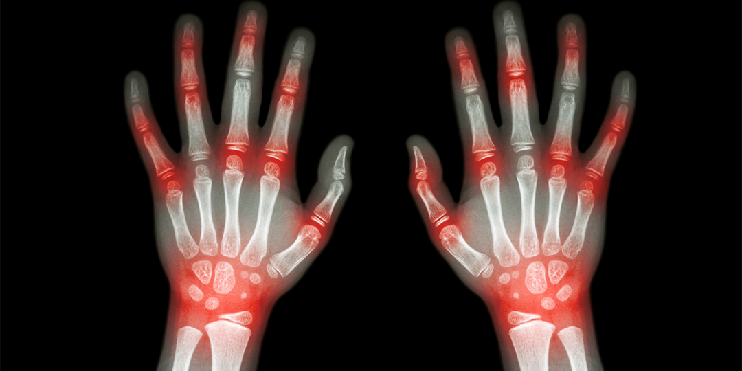 Шишки на пальцах и кривые суставы: почему это опасно и что делать