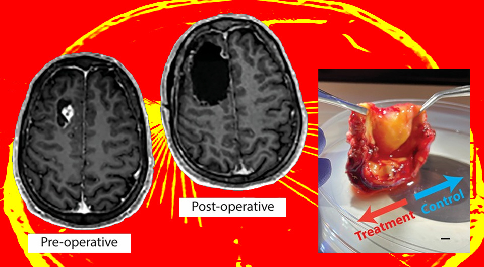   N + 1; Nader Sanai et al. / Science Translational Medicine, 2025
