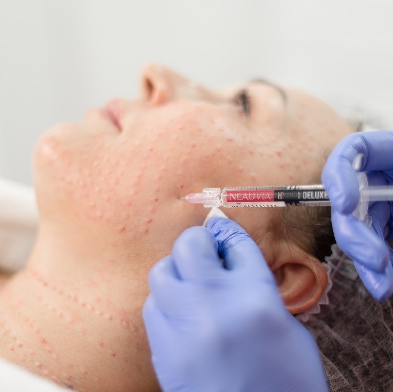 Если кожа обезвожена, эффект будет заметно слабее, поэтому рекомендуют подготавливать её биоревитализацией