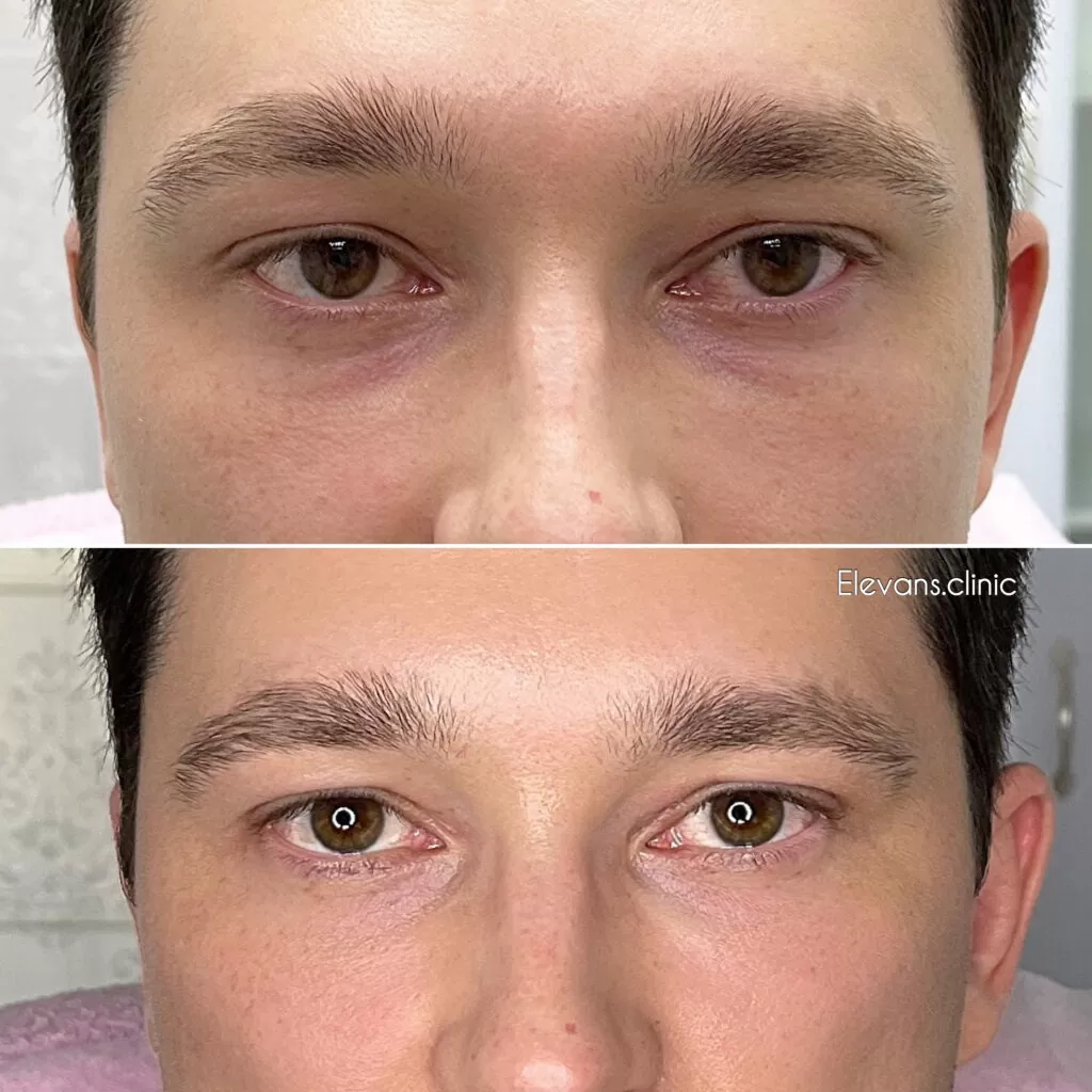 Реальные фото наших клиентов до и после процедуры