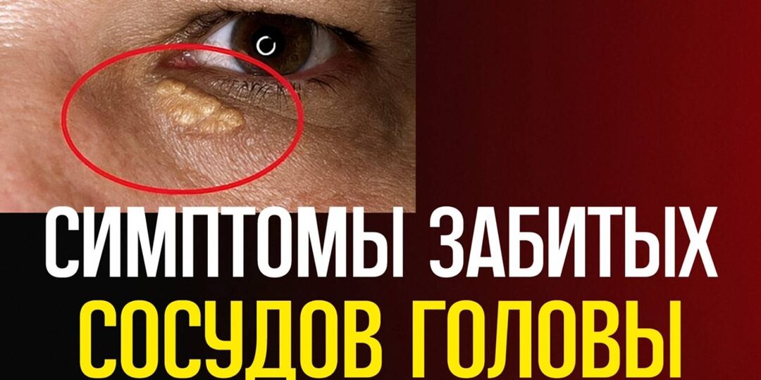 7 Симптомов, Что Сосуды Мозга Теряют Эластичность (чек-лист)