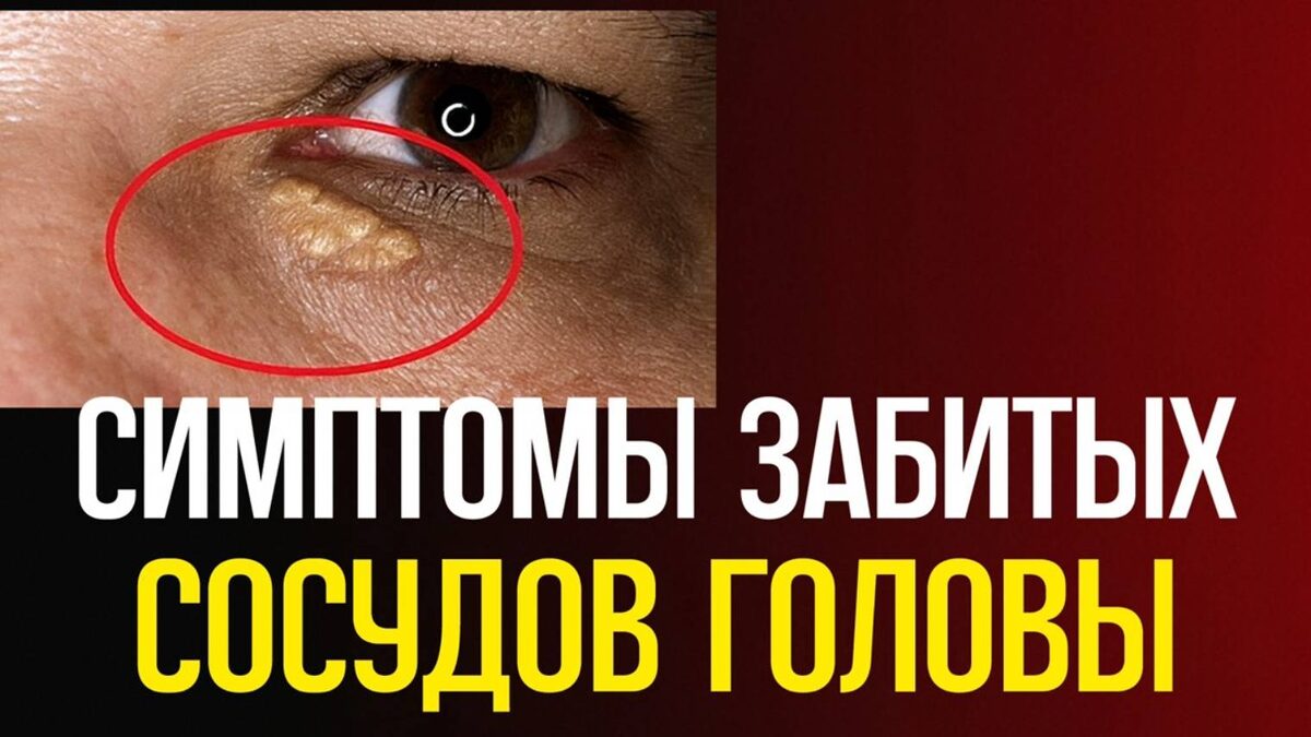 7 Симптомов, Что Сосуды Мозга Теряют Эластичность (чек-лист)