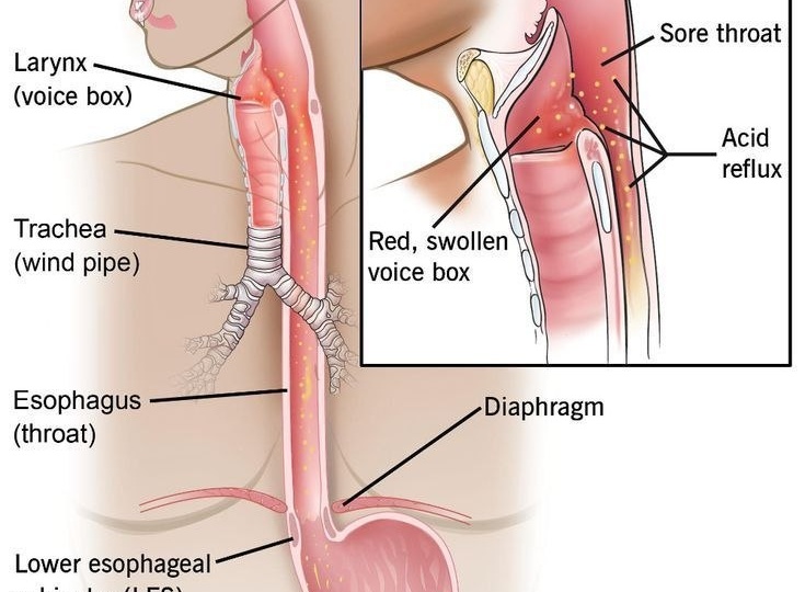 Когда гастроэнтеролог лечит кашель? Всё о «тихом» рефлюксе.