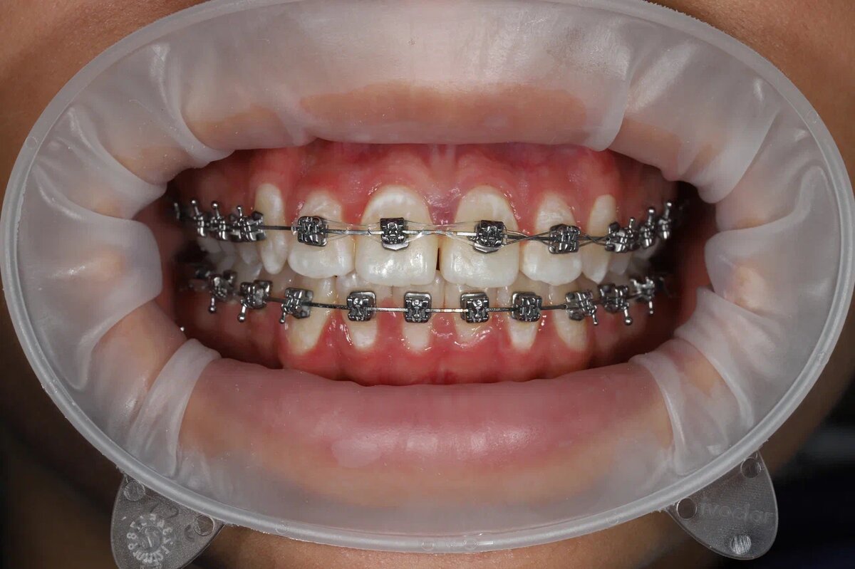 Брекеты — это замочки, которые ортодонт фиксирует на весь период ортодонтического лечения, и для пациента эта конструкция несъемная